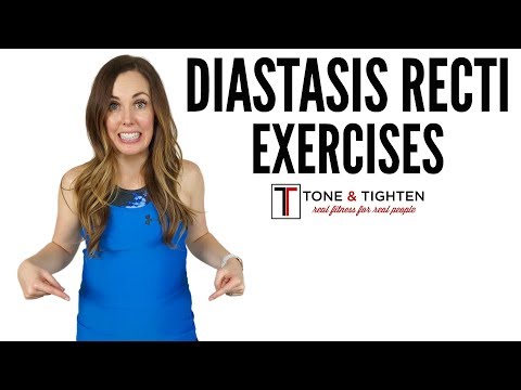 Diastasis Recti Exercises - From a doctor of physical therapy